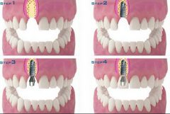 极光口腔-种植牙的流程