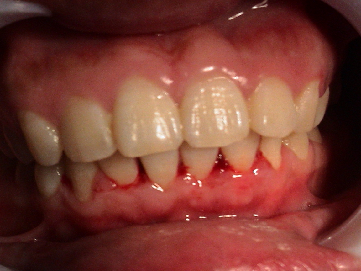 牙龈问题，牙周病如何自我治疗？ - 知乎