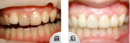 瓷贴面治疗色素牙好不好