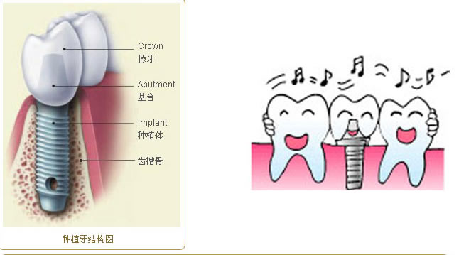 种植牙