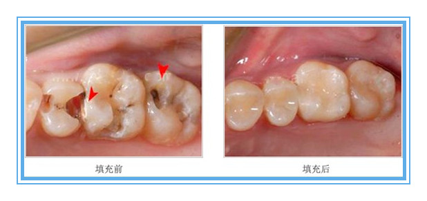 成都儿童蛀牙要怎么办