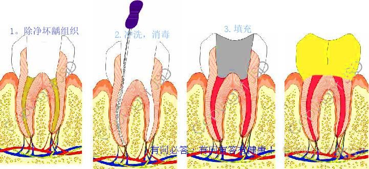 根管治疗7