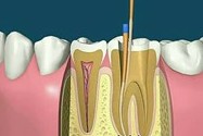 根管治疗